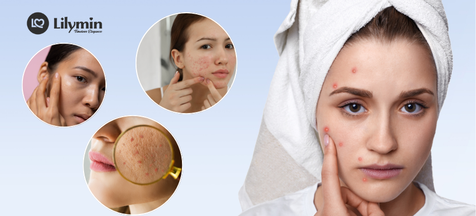 How to Repair Damaged Skin Barrier at Home