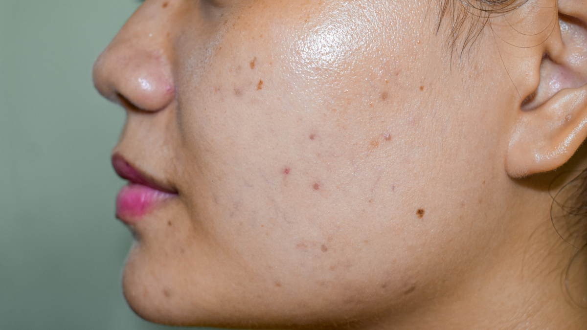 Pigmentation