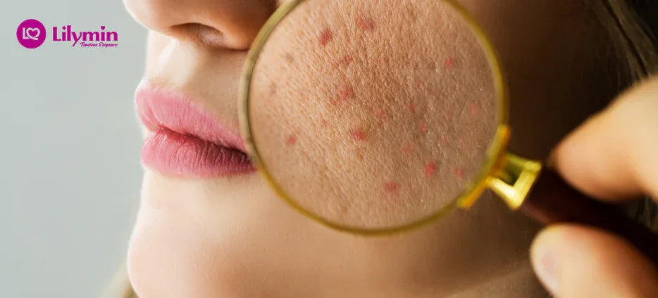 Pigmentation in Hindi 